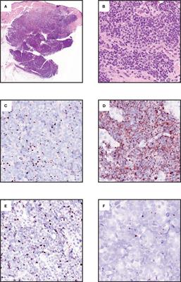 Merkel cell carcinoma: updates in tumor biology, emerging therapies, and preclinical models